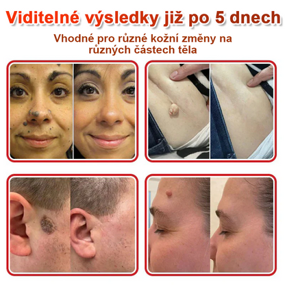 🎆COLTURE® Mikrovpichová botanická náplast na odstranění kožních výrůstků✨✨