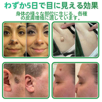 本日限定80%OFF📌 Hudros® 2in1 マイクロニードル＆ハイドロコロイドパッチ｜ニキビ・肌荒れ・肌悩みを集中ケア｜目立ちにくい星型パッチ｜顔・ボディ用｜144枚入り