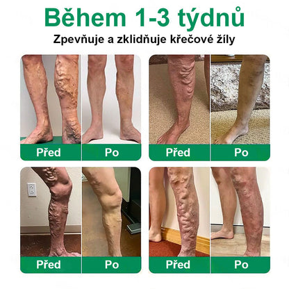 🔥Twisma® VeinTarget – Pokročilá mikro náplast na křečové žíly 🔥 96 % klinicky prokázaná účinnost ⚡ Viditelné výsledky už za 7–14 dní 🌿 Šetrná podpora pro lehčí a uvolněnější nohy 🦵✨