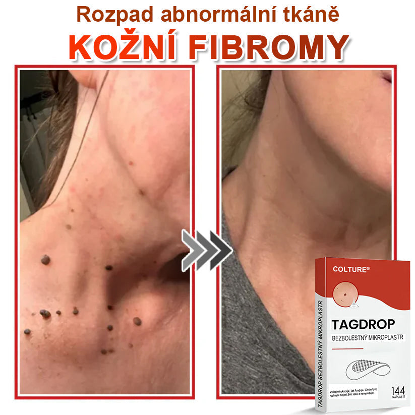 🎆COLTURE® Mikrovpichová botanická náplast na odstranění kožních výrůstků✨✨