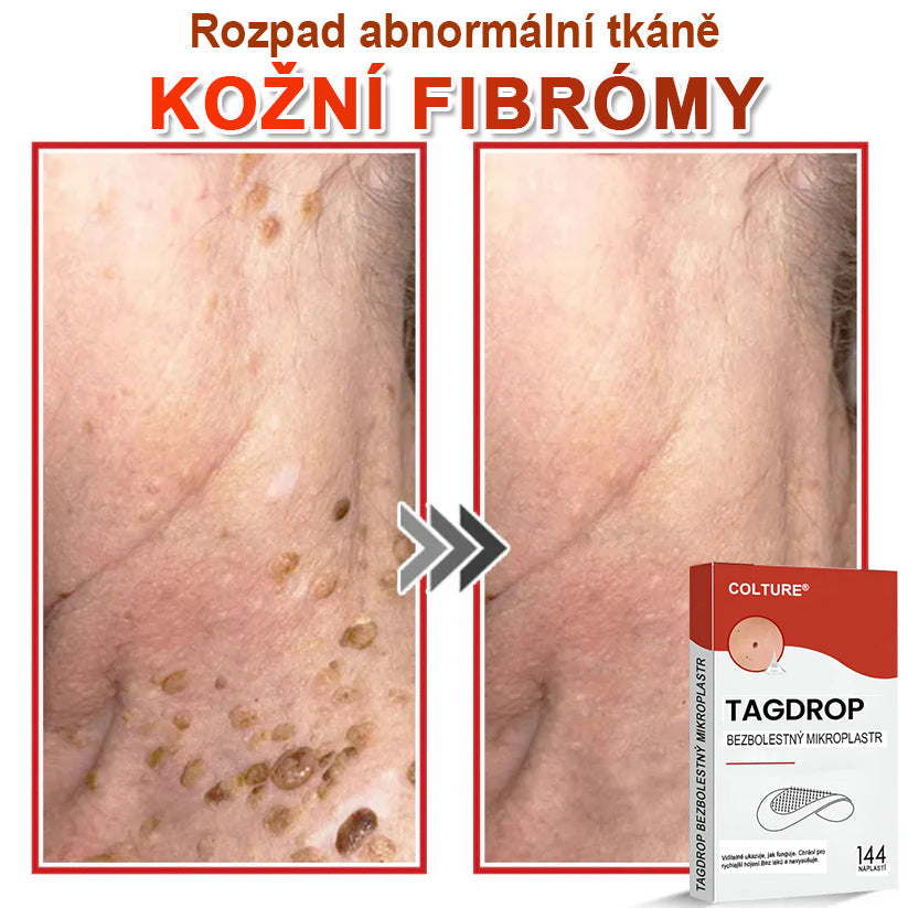 🎆COLTURE® Mikrovpichová botanická náplast na odstranění kožních výrůstků✨✨