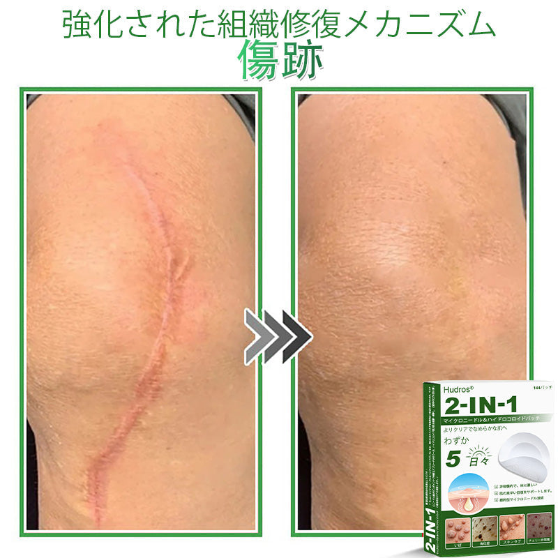 本日限定80%OFF📌 Hudros® 2in1 マイクロニードル＆ハイドロコロイドパッチ｜ニキビ・肌荒れ・肌悩みを集中ケア｜目立ちにくい星型パッチ｜顔・ボディ用｜144枚入り