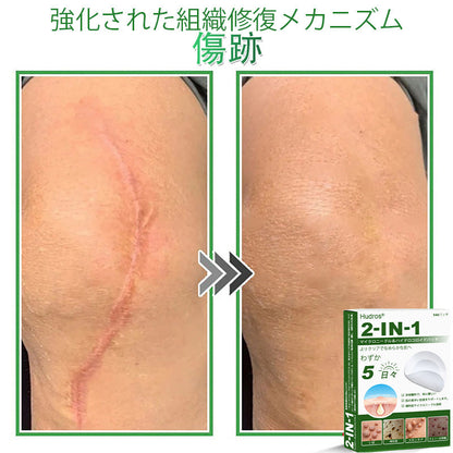 本日限定80%OFF📌 Hudros® 2in1 マイクロニードル＆ハイドロコロイドパッチ｜ニキビ・肌荒れ・肌悩みを集中ケア｜目立ちにくい星型パッチ｜顔・ボディ用｜144枚入り