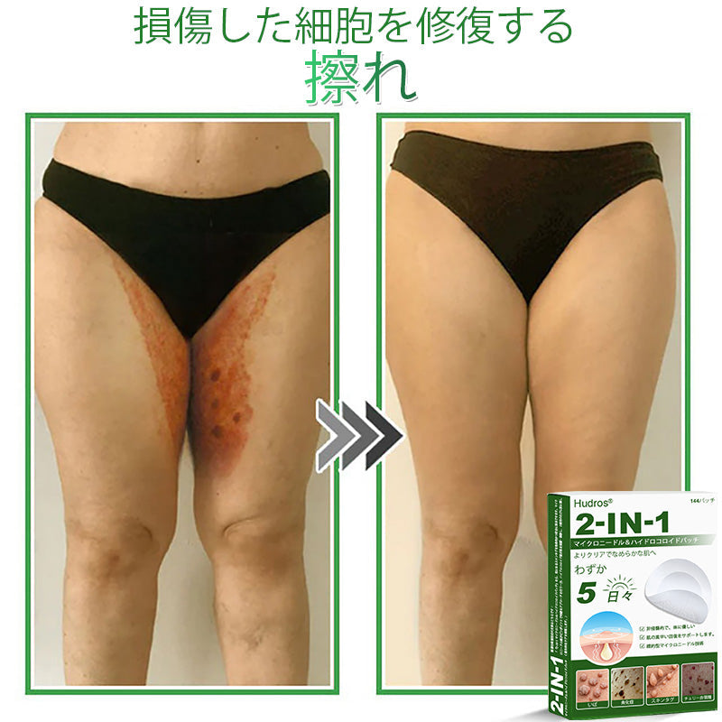本日限定80%OFF📌 Hudros® 2in1 マイクロニードル＆ハイドロコロイドパッチ｜ニキビ・肌荒れ・肌悩みを集中ケア｜目立ちにくい星型パッチ｜顔・ボディ用｜144枚入り