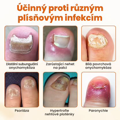Sprej na opravu nehtů Timilk® FungiBee Advanced⭐️